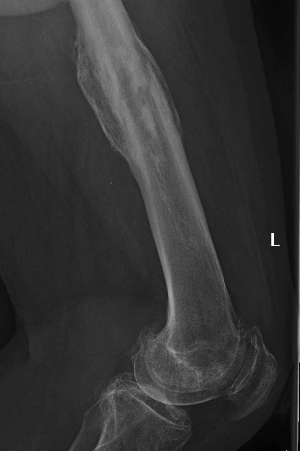 TKR Previous Femoral Fracture